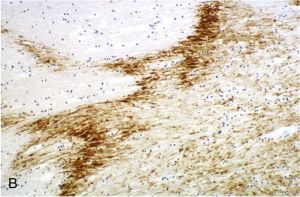 In vascular axonal injury, a zigzag pattern of amyloid precursor protein (APP)-immunopositive axonal injury occurs secondary to ischemia caused by internal herniation resulting from raised intracranial pressure (APP immunostain, corpus callosum; ×100).