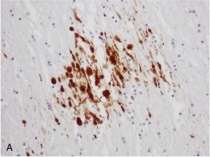 In traumatic axonal injury, amyloid precursor protein (APP)-immunopositive axonal injury shows a spectrum of axonal abnormalities, including axonal swellings, axonal retraction bulbs, and immunoreactive lengths (APP immunostain, corpus callosum; ×200).