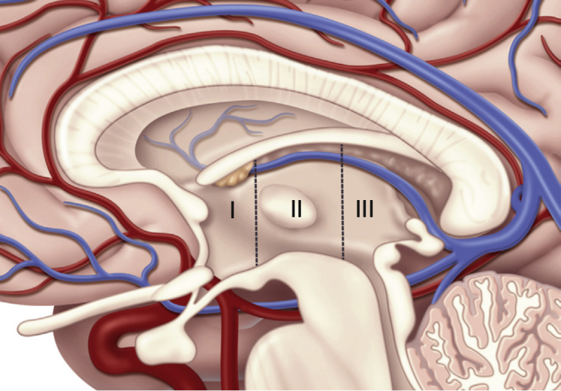File:Anatomic risk zones for colloid cysts of the third ventricle.png